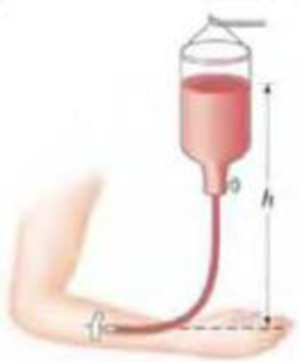 Chapter 13, Problem 71P, (III) A patient is to be given a blood transfusion. The blood is to flow through a tube from a 