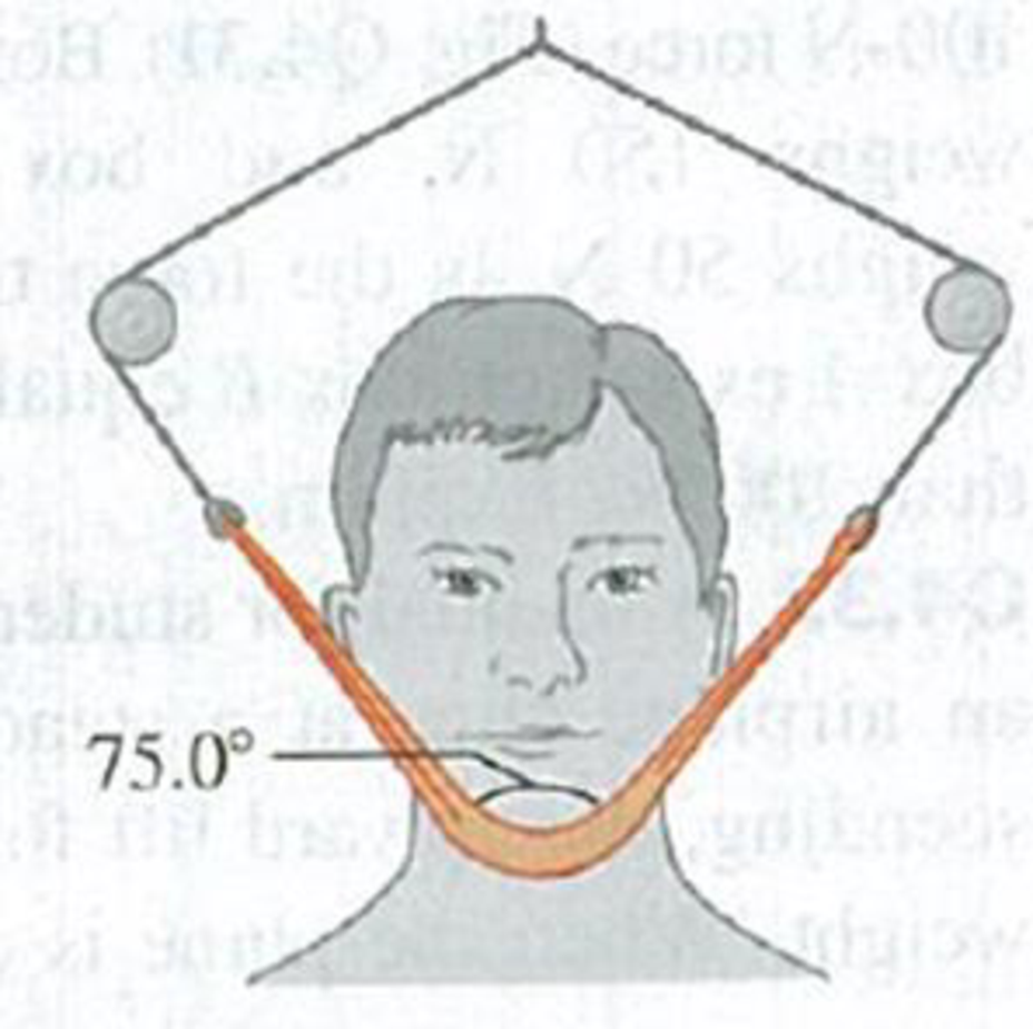 Chapter 4, Problem 4.3E, BIO Jaw Injury. Due to a jaw injury, a patient must wear a strap (Fig. E4.3) that produces a net 