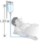Chapter 13, Problem 17P, Intravenous feeding. A hospital patient is being fed intravenously with a liquid of density 1060 