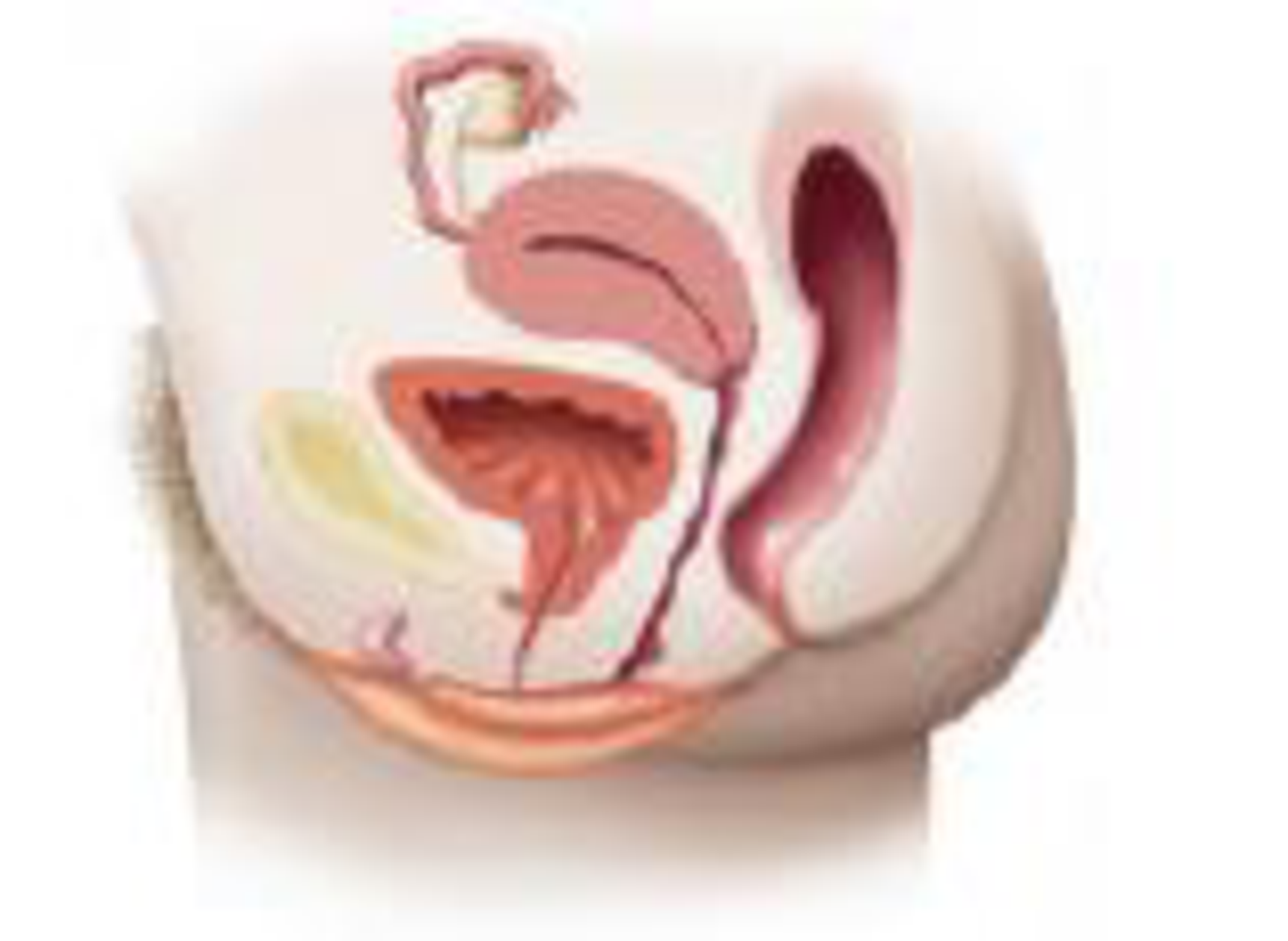 Chapter 26, Problem 1R, coli to cause cystitis. Do the same for pyelonephritis. Diagram the pathway taken by Neisseria 