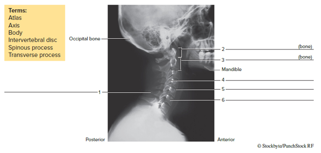Chapter 15, Problem F15.9A, FIGURE 15.9 Identity the bones and features indicated in this radiograph of the neck (lateral view), 