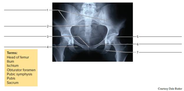 Chapter 17, Problem F17.6A, Identify the bones and features indicated in the radiographs of figures 17.6, 17.7, and 17.8. FIGURE 